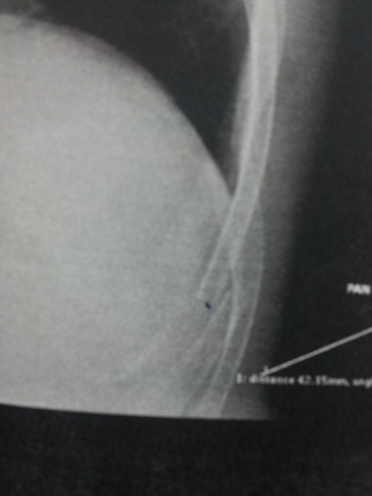 The black mark shows one end of the fractured rib. The other end is to the right. 